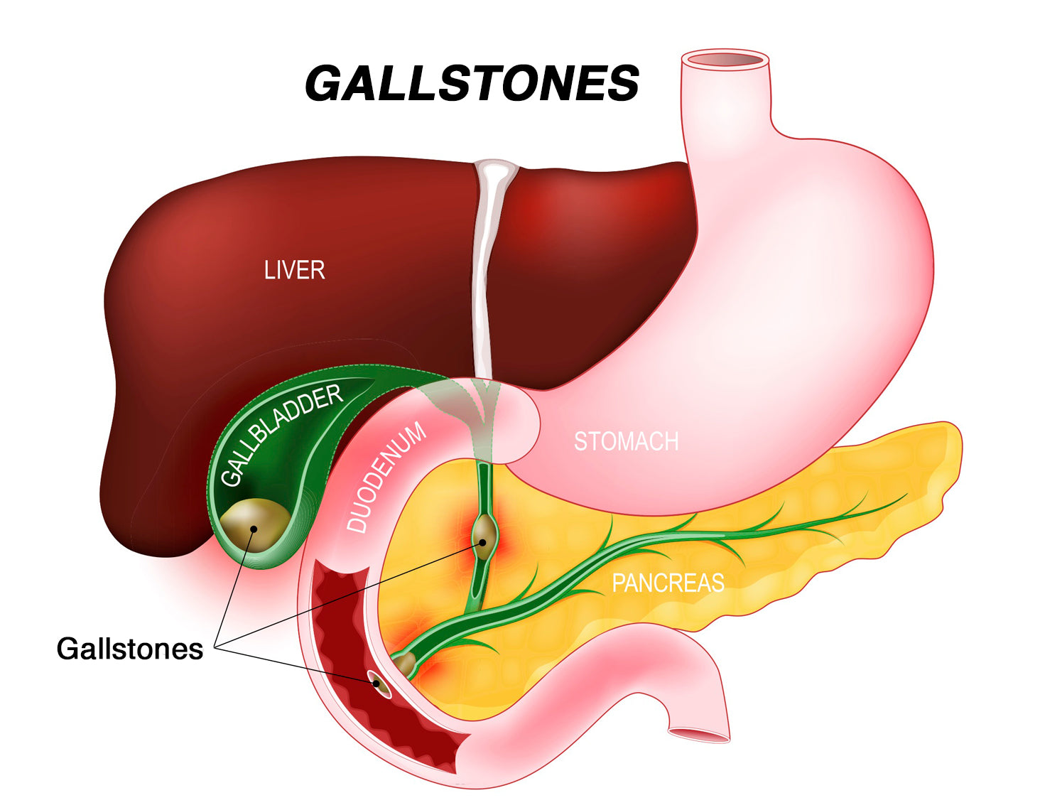 Gastroenterology Made Ridiculously Simple