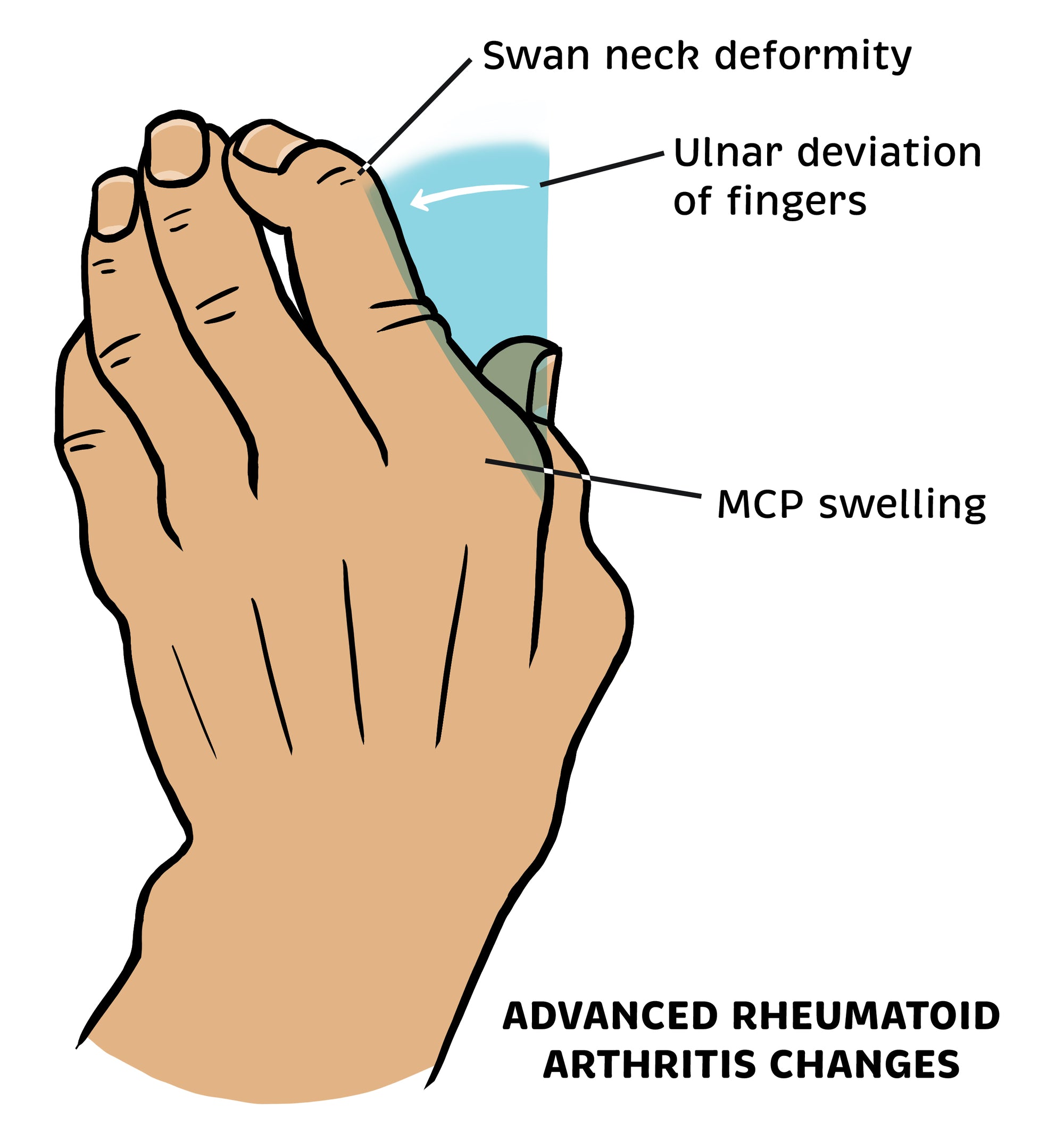 Rheumatology Made Ridiculously Simple