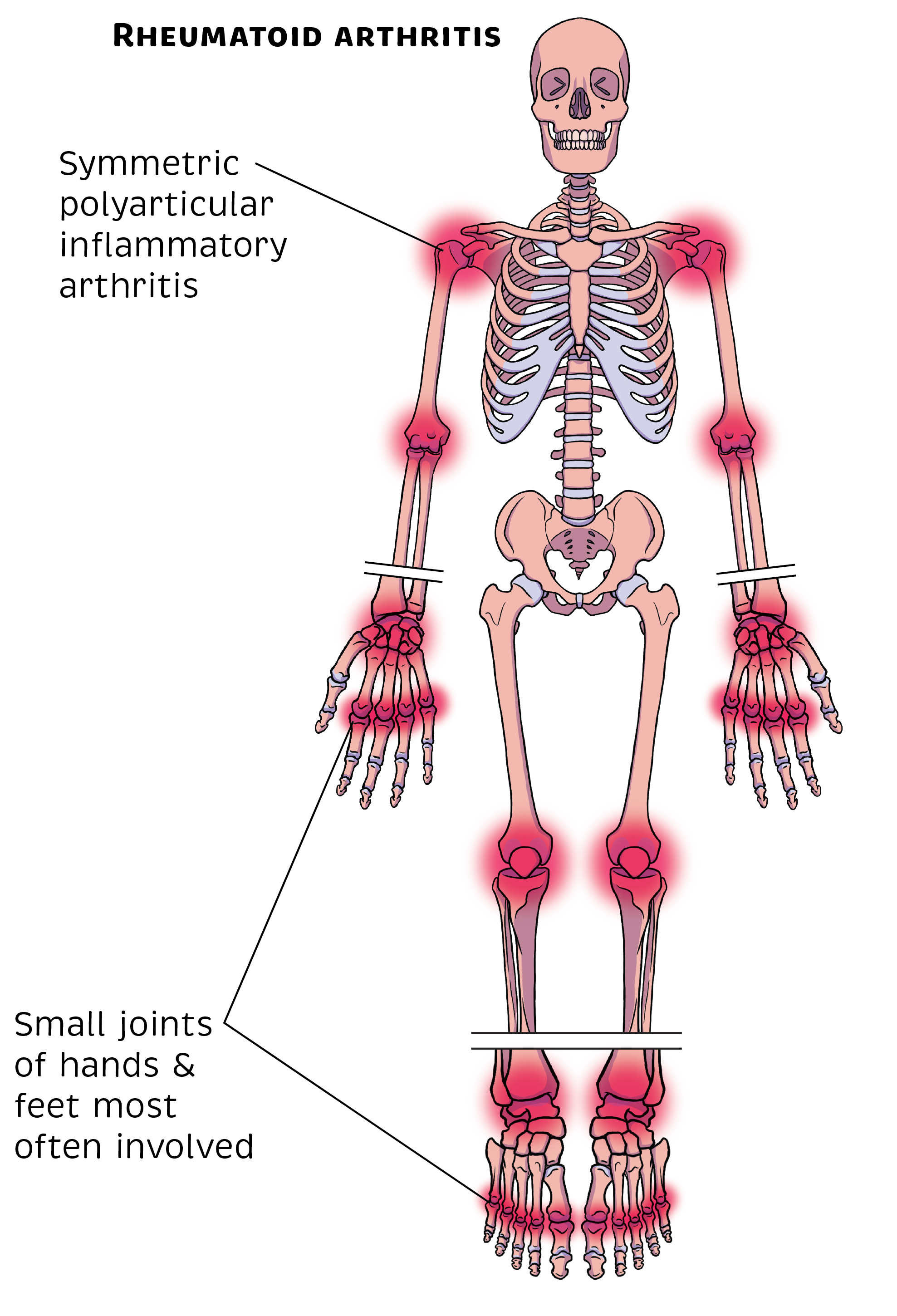 Rheumatology Made Ridiculously Simple