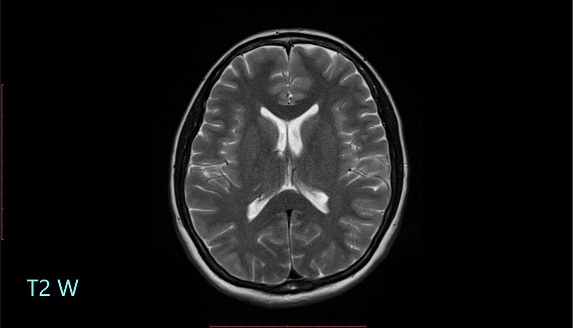 Neurology Made Ridiculously Simple